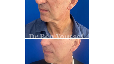 Avant et après hifu | Dr Ben Youssef | Paris