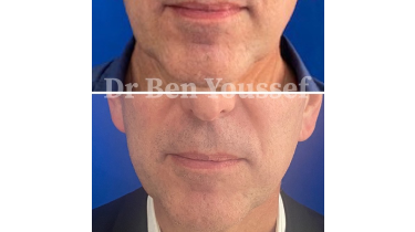 Avant et après hifu | Dr Ben Youssef | Paris