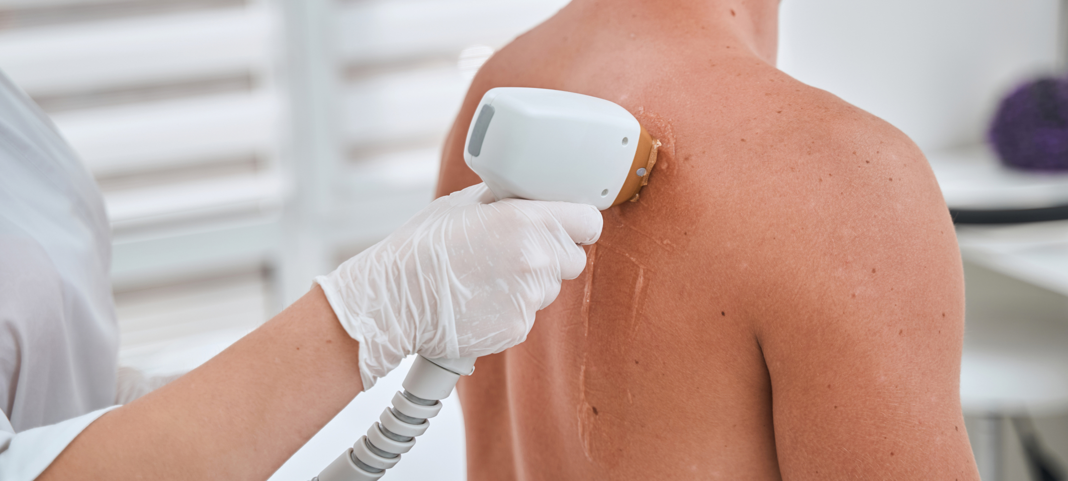 Épilation laser hommes même efficacité femmes | Dr Heyfa Ben Youssef | Paris