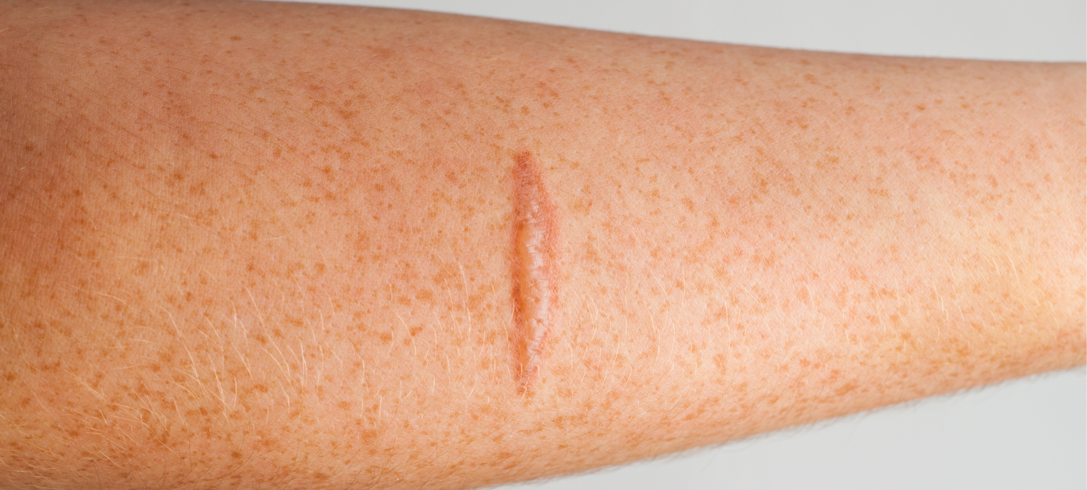 Cicatrices pas traitées laser médical | Paris