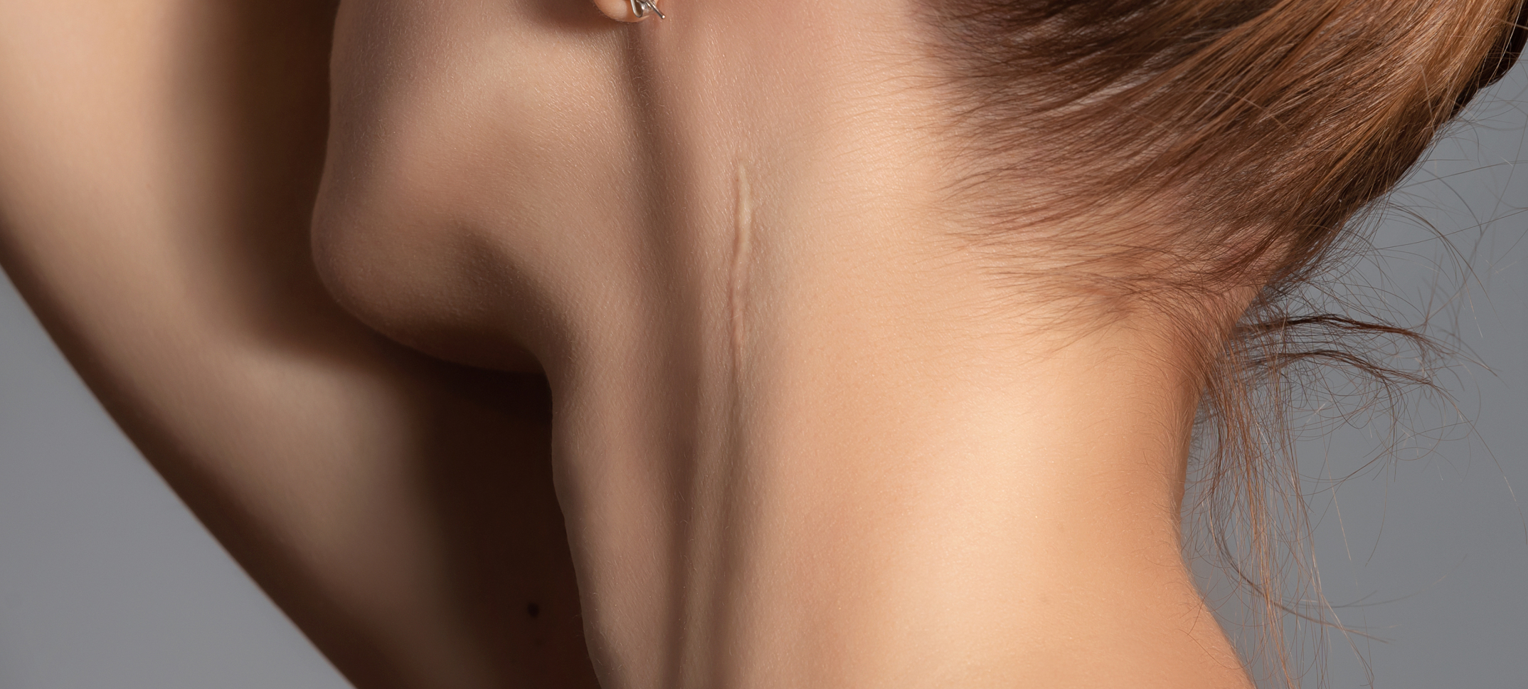 Quelles sont différentes solutions atténuer cicatrices | Dr Heyfa Ben Youssef | Paris