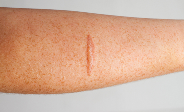 Cicatrices pas traitées laser médical | Paris