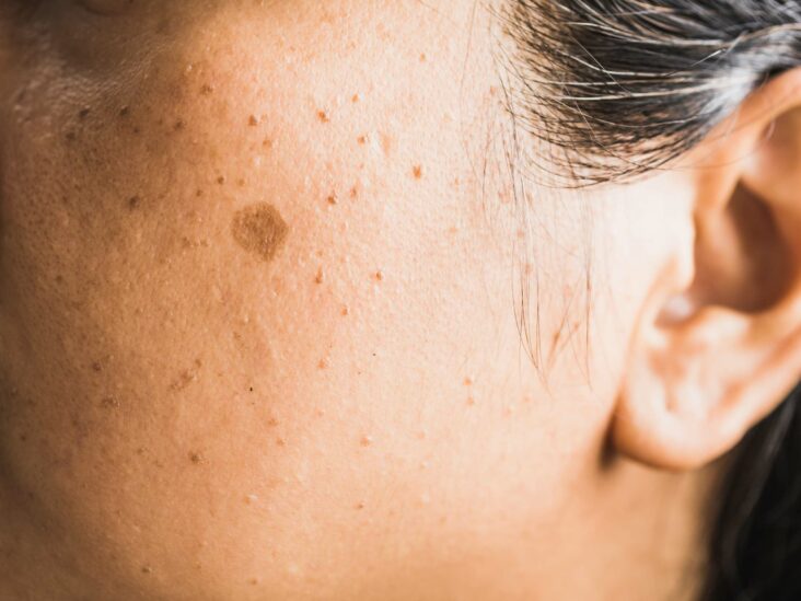 Pourquoi ai-je des taches brunes qui apparaissent sur mon visage ? | Dr Heyfa Ben Youssef | Paris