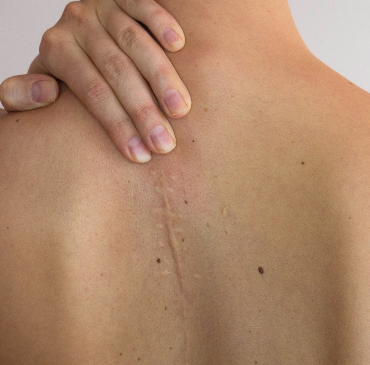 Cicatrices cutanées : causes et traitements | Dr Ben Youssef | Paris 8