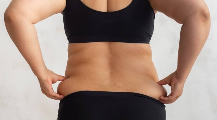 Dos d'une femme ronde avec la cellulite dans les hanches | cryolipolyse | Dr Ben Youssef Paris