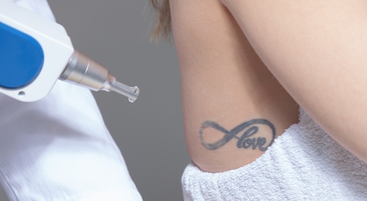 Tatouage sous le bras d'une jeune femme | Détatouage laser | Dr Ben Youssef Paris